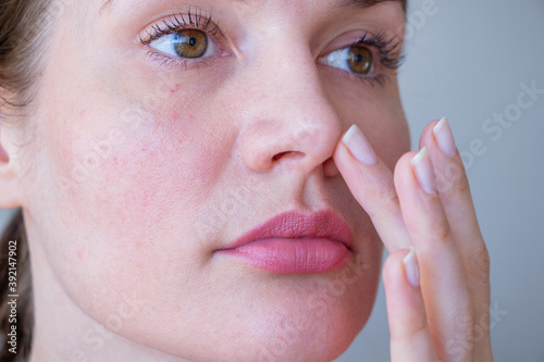 
Young woman with rosacea problem on face