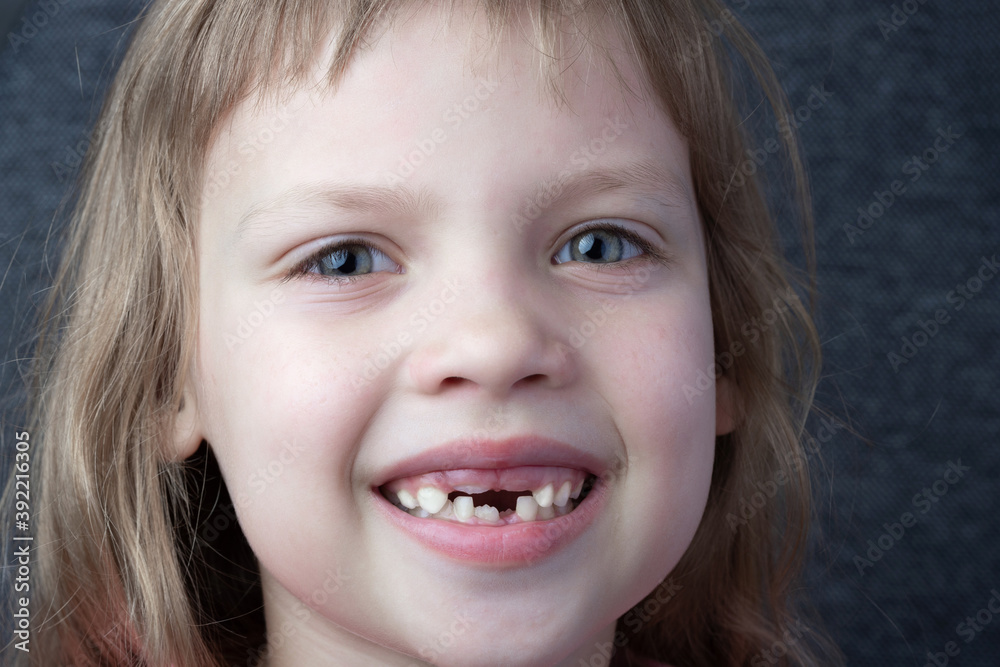 The smile of a child of six with growing molars. Change of deciduous teeth (baby, milk, temporary, primary teeth) to molars. The smile of a child of six with growing molars. Change of deciduous teeth (baby, milk, temporary, primary teeth) to molars.