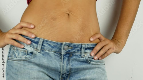 A young woman is showing her weight loss and stretch marks on her stomach. A woman in large jeans shows how she lost weight after giving birth and stretch marks on her stomach. Close-up of a woman's b