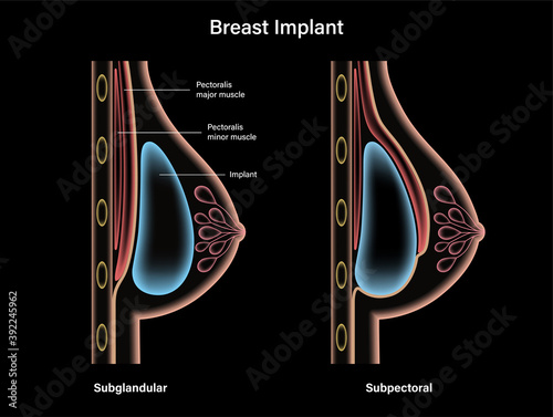 Breast Implant Concept