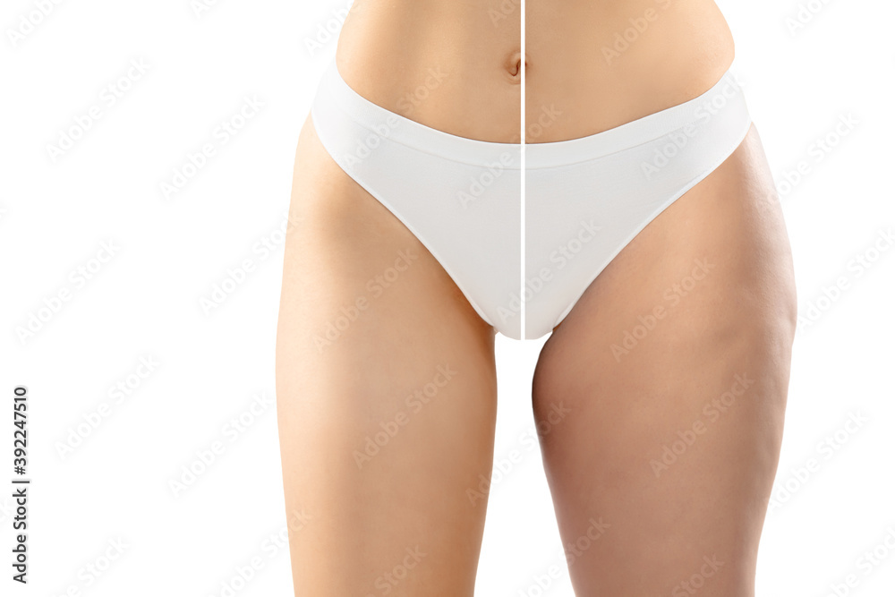 Overweight woman with cellulite legs and belly in white underwear comparing with fit and thin body isolated on white background. Orange peel skin, liposuction, healthcare, beauty, sport, surgery. - obrazy, fototapety, plakaty 