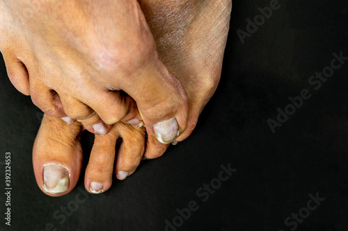 Female feet close-up with nails affected by a fungus on a black background. Foot health and hygiene. photo