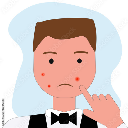 Portrait of young man with acne problem squishing pimples on light background