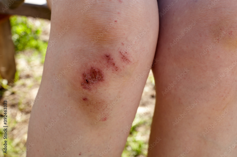 Sport injury - painful knee wound accident. Close up of bleeding scraped human knee after fallen on running Sport injury - painful knee wound accident. Close up of bleeding scraped human knee after fallen on running