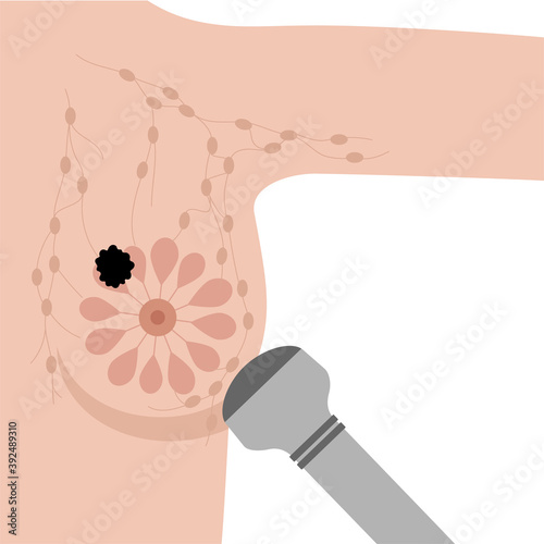 Breast disease concept