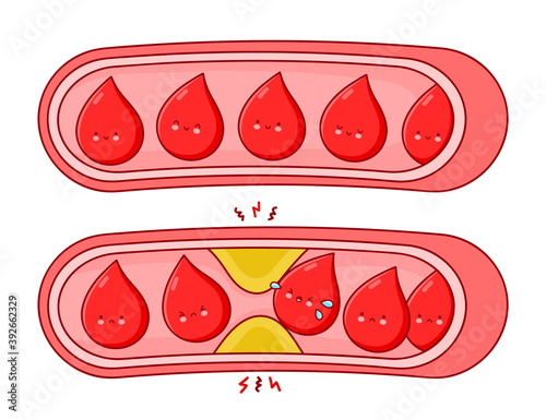 Normal and clogged blood vessels