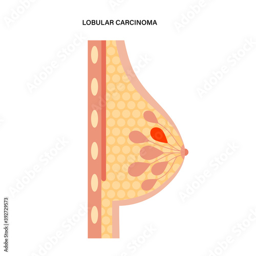 Breast disease concept