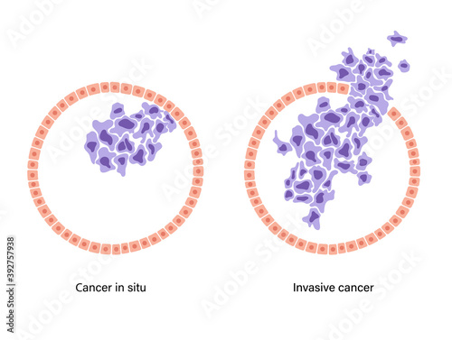 Breast disease concept