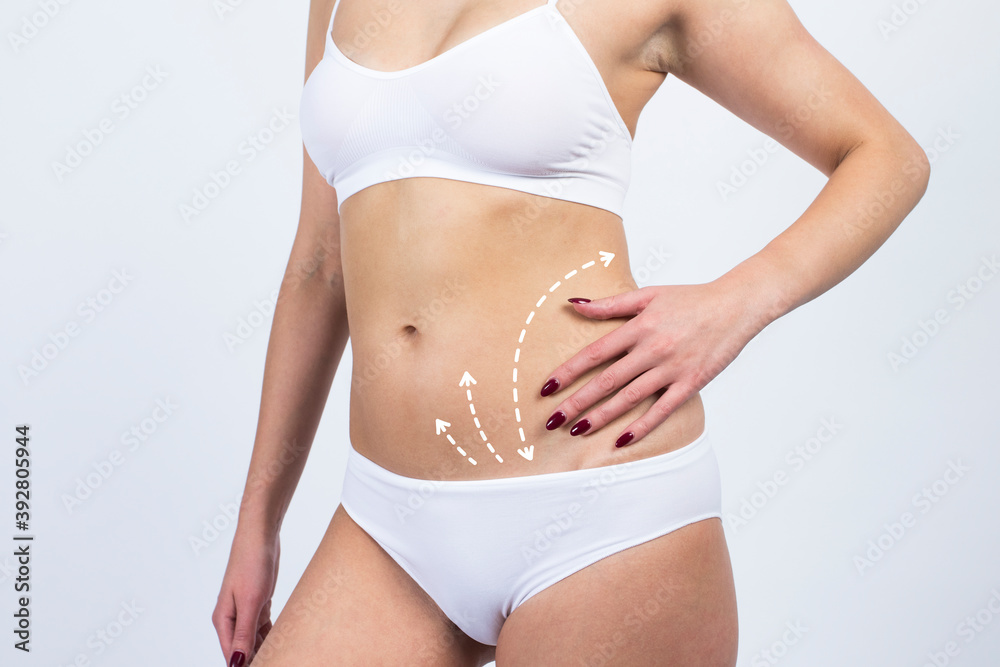 Cellulite removal scheme on body girl. White arrows markings on belly young girl.