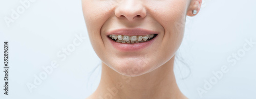 Canvastavla Female smile with braces on teeth