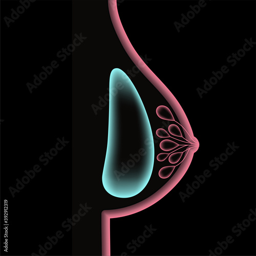 Breast Implant Concept