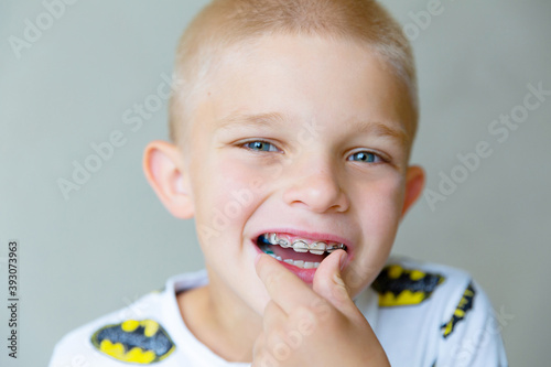 A blond boy inserts a baby orthodontic plate into his mouth. Close up	
