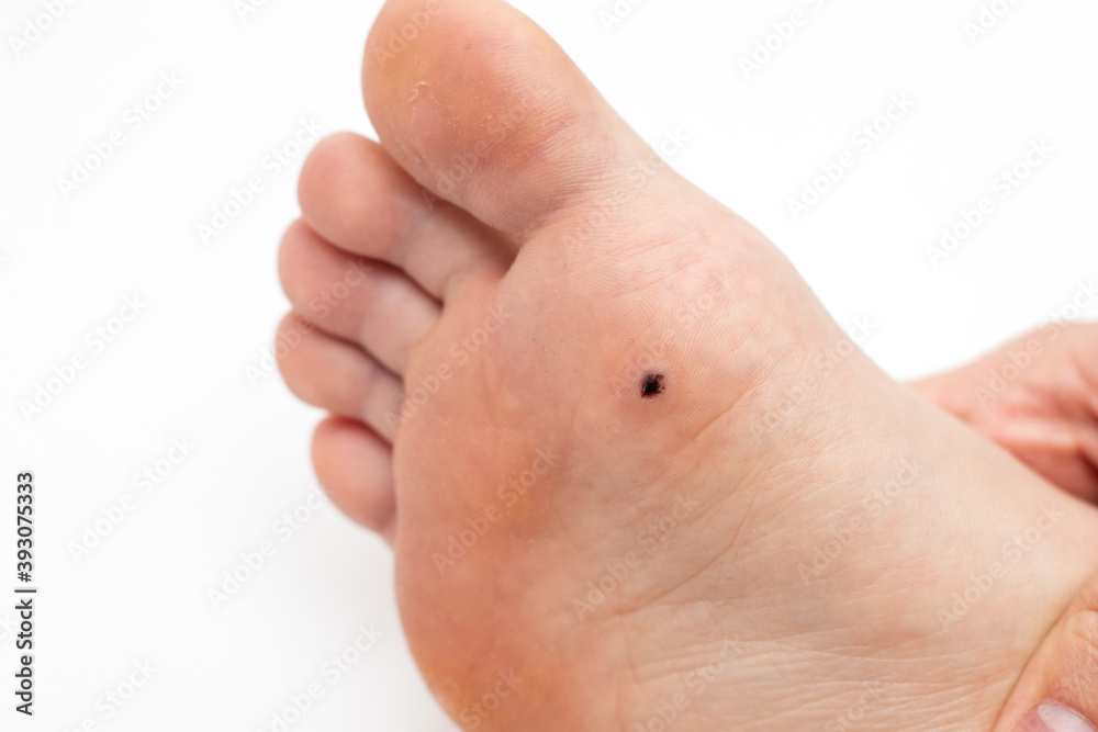 Wart on the sole of the foot. Removal of a plantar wart Stock Photo