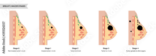 Breast disease concept