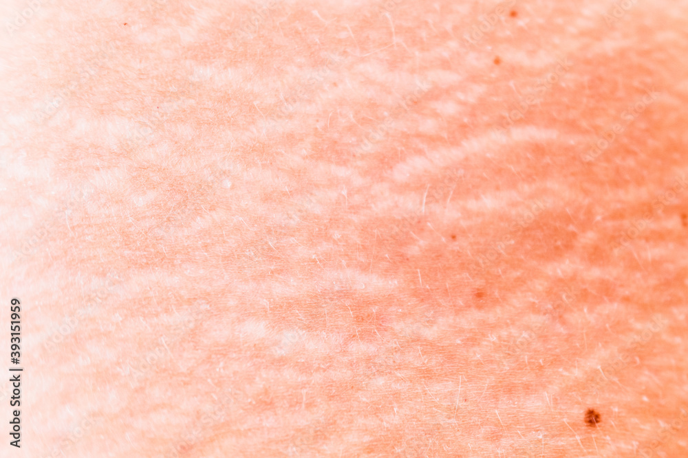 Stretch marks on the skin of a middle-aged woman, detail. Stretch marks on the skin of a middle-aged woman, detail.