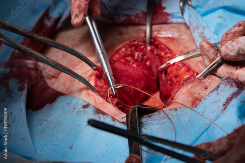 Surgical needle and thread in a clamp during the hysterectomy surgery detail