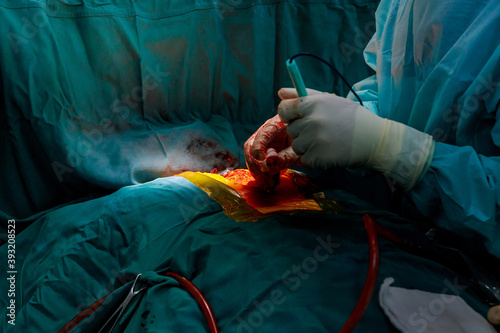 Surgeon surgery and team perform thoracic surgery in case lung cancer