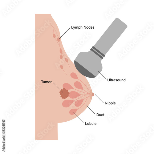 Breast disease concept