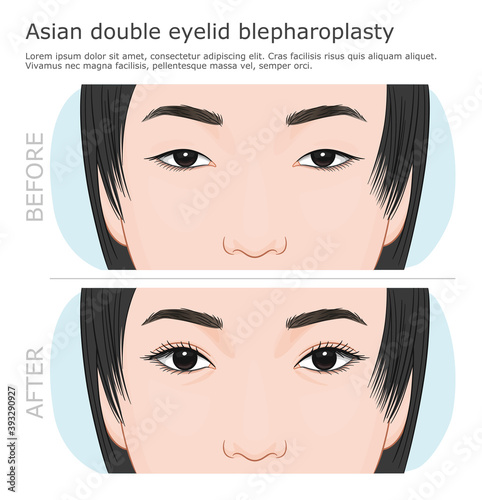 Asian double eyelid blepharoplasty surgery