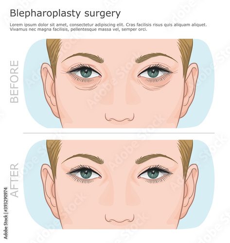 Lower and upper rejuvenation blepharoplasty surgery illustration. Rejuvenating procedure. Wrinkles around the eyes before and after. 