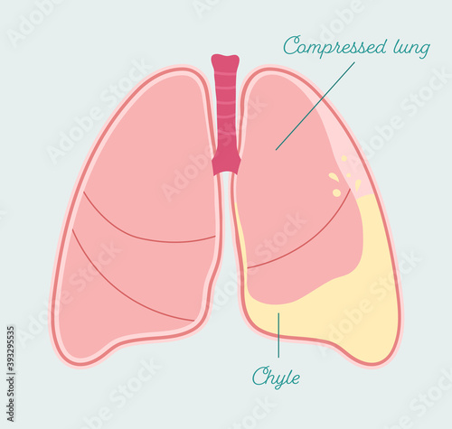 Chylothorax - anatomical scheme in hand drawn style. Gathering of chyle or lymph fluid in pleural space, type of pleural effusion. Patient-friendly infographic, vector medical scheme