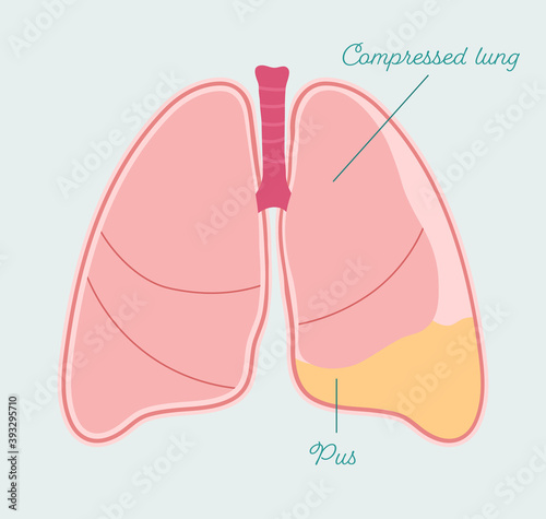Pleural empyema - anatomical scheme in hand drawn style. Gathering of pus in pleural space, type of pleural effusion. Patient-friendly infographic, vector medical scheme photo