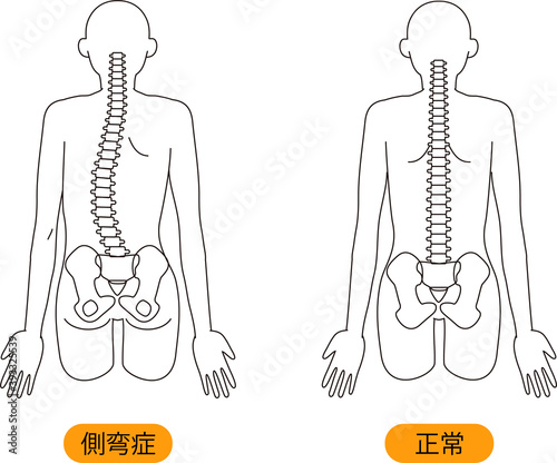 メディカル　姿勢（側弯症） 上半身　背面