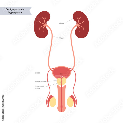 BPH info concept