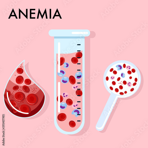 Anemia concept.Glass laboratory test tube and magnifier with blood analysis.Decrease of Erythrocytes or low hemoglobin.Iron deficiency in serum.Leukocytes,neutrophil.Drop with red cells.Medical poster