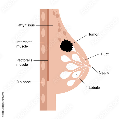 Breast disease concept