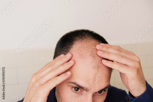 Male pattern hair loss problem concept. Young caucasian man looking at mirror worried about balding. Baldness, alopecia in males. photo