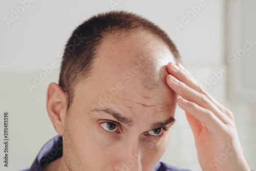 Male pattern hair loss problem concept. Young caucasian man looking at mirror worried about balding, close up. Baldness, alopecia in males. photo