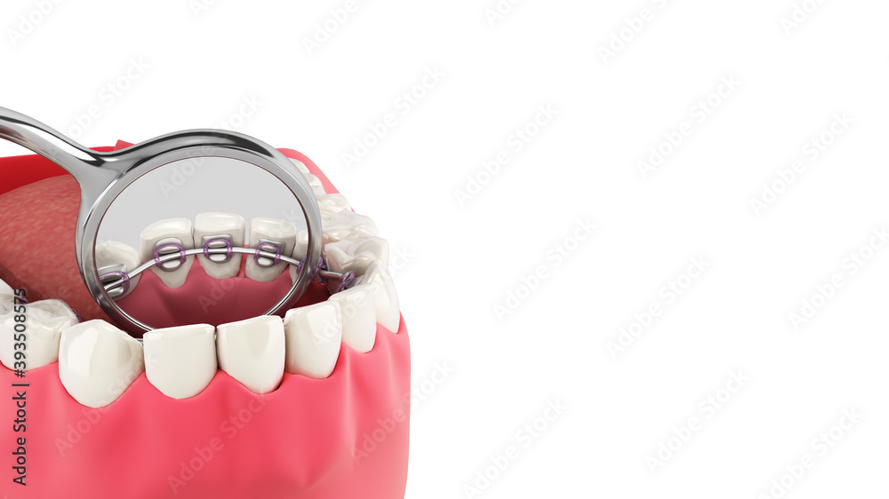 Lingual braces system on a demonstration denture 3d close up on white