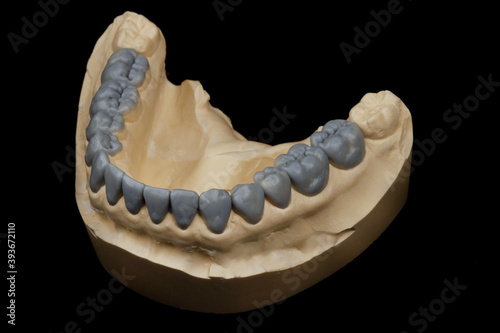 wax-up smile design 