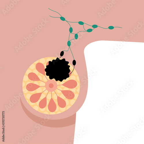Breast disease concept
