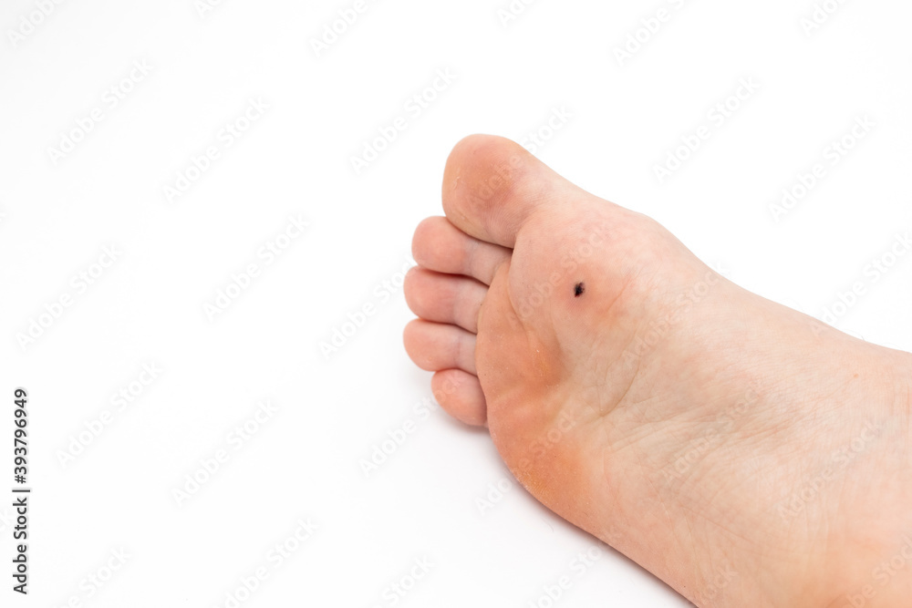 Black wart on the foot. Sore after removal of the wart. Black wart on the foot. Sore after removal of the wart.