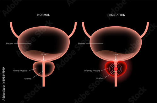 Prostatitis inflammation problem