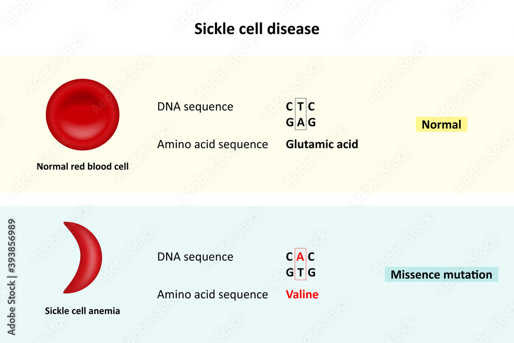 Sickle cell disease, Comparison of DNA sequence between Normal red blood  cell and Sickle cell anemia, Scientific study Stock Vector | Adobe Stock