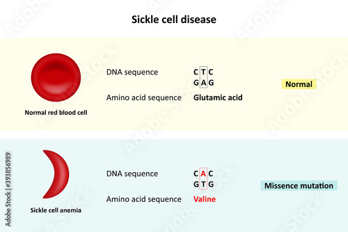 Sickle cell disease, Comparison of DNA sequence between Normal red blood cell and Sickle cell anemia, Scientific study