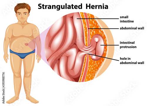 Man Strangulated Hernia Diagram