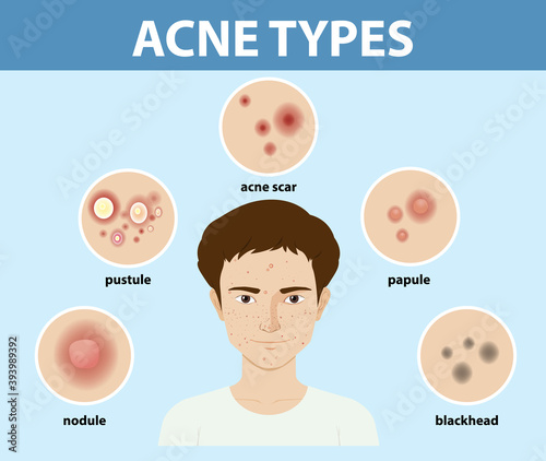 Types of acne on the skin or pimples