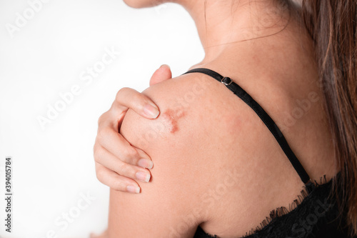 Asian women have keloid scar on shoulder and hand touch, on white background, dermatology and cosmetology concept. photo