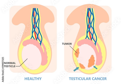 Testicular Disorder men vas pus tube male pain cyst test exam self cord vein sperm Acute blood semen tract penis viral virus tumor fluid testes pelvic sexual penile trauma system prostate testis