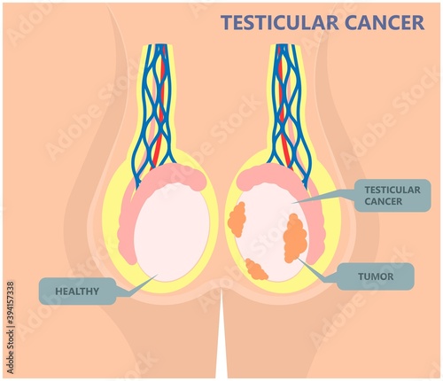 Testicular Disorder men vas pus tube male pain cyst test exam self cord vein sperm Acute blood semen tract penis viral virus tumor fluid testes pelvic sexual penile trauma system prostate testis