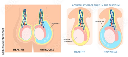 Testicular Disorder men vas pus tube male pain cyst test exam self cord vein sperm Acute blood semen tract penis viral virus tumor fluid testes pelvic sexual penile trauma system prostate testis