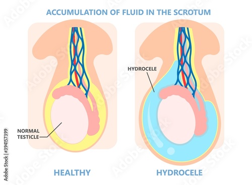 Testicular Disorder men vas pus tube male pain cyst test exam self cord vein sperm Acute blood semen tract penis viral virus tumor fluid testes pelvic sexual penile trauma system prostate testis