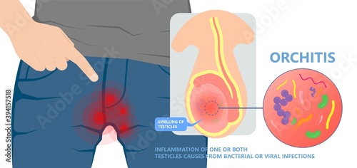 Testicular Disorder men vas pus tube male pain cyst test exam self cord vein sperm Acute blood semen tract penis viral virus tumor fluid testes pelvic sexual penile trauma system prostate testis