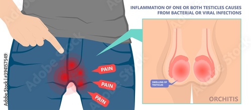 Testicular Disorder men vas pus tube male pain cyst test exam self cord vein sperm Acute blood semen tract penis viral virus tumor fluid testes pelvic sexual penile trauma system prostate testis