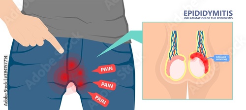 Testicular Disorder men vas pus tube male pain cyst test exam self cord vein sperm Acute blood semen tract penis viral virus tumor fluid testes pelvic sexual penile trauma system prostate testis