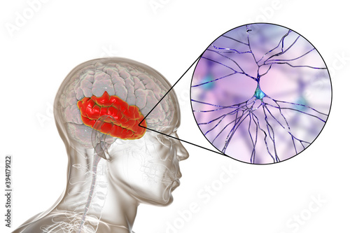 Human brain with highlighted temporal lobe and close-up view of neurons photo